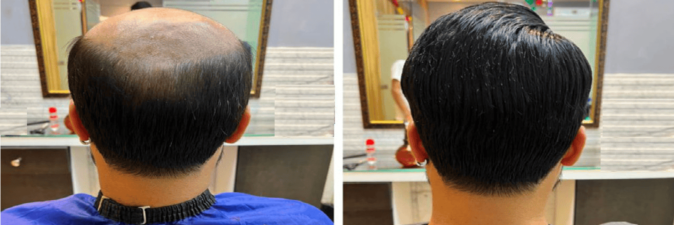 Hair Bonding Service in Ghaziabad - The Hair Solution